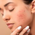 Young,Woman,With,Closed,Eyes,Touching,Face,With,Acne,Isolated